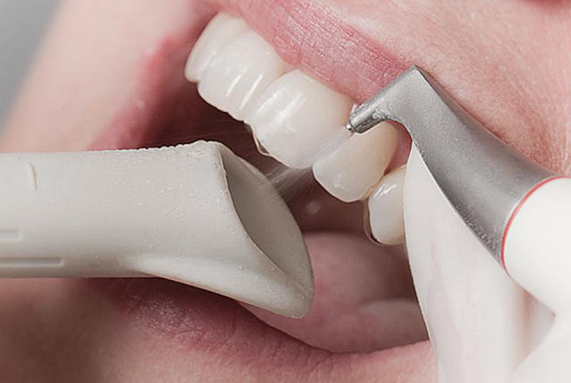 Какую слепочную массу выбрать в стоматологии?