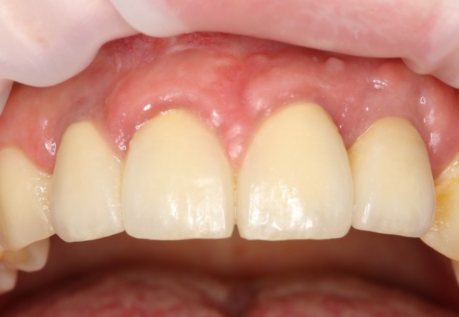 Делаем свои зубы белоснежными и здоровыми. Протезирование и имплантация зубов