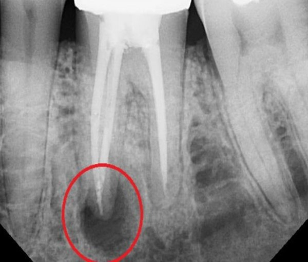 Лечение гранулемы зубов