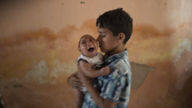 Вспышка Зика в Бразилии: Еще больше новорожденных с характерными дефектами