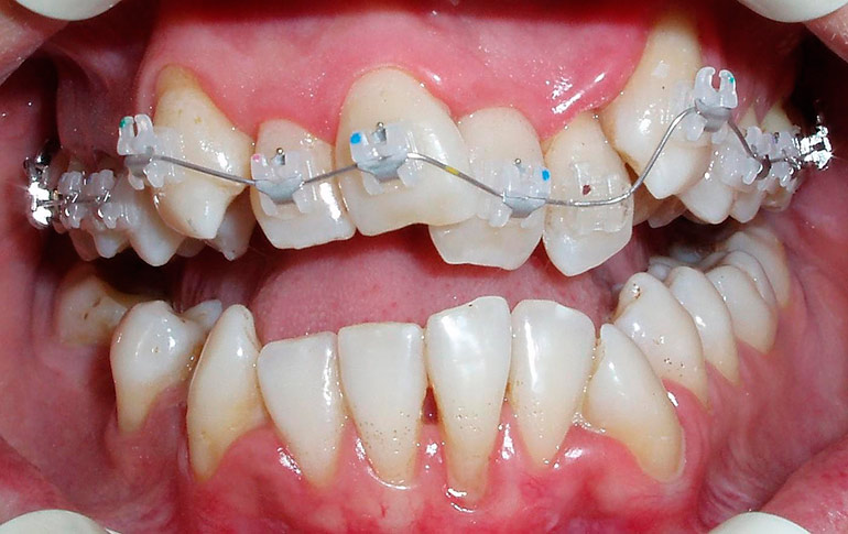 Брекеты в детской стоматологии