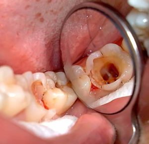 Революционный процесс. Понимание и лечение каналов зуба